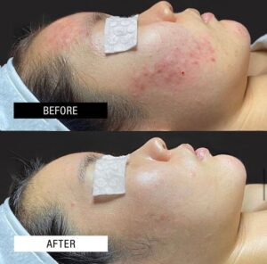 peeling ph formula anti acné